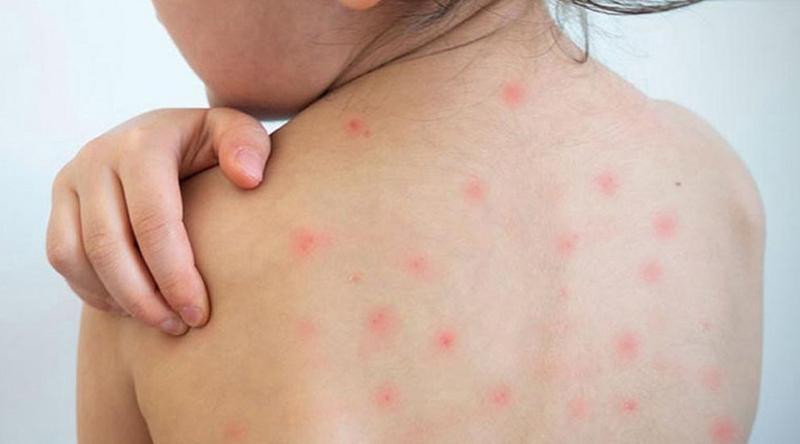 হামে আক্রান্ত হয়ে আরও ৪ জনের মৃত্যু