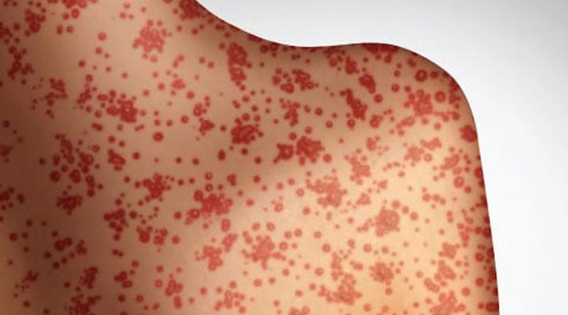 ২৪ ঘণ্টায় দেশে হামে আক্রান্ত ৯৪৭ জন, মৃত্যু ৩