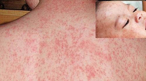 হাম হলে দ্রুত সুস্থতা দেবে ৫ পানীয়