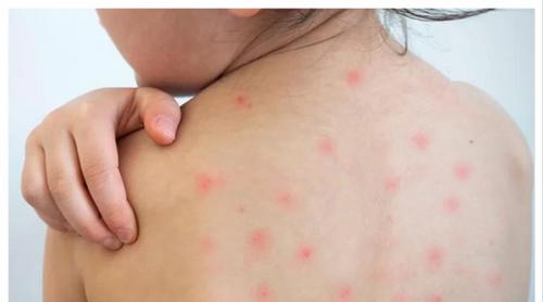 ২৪ ঘণ্টায় হাম ও হামের উপসর্গ নিয়ে দেশে আরও ১১ জনের মৃত্যু