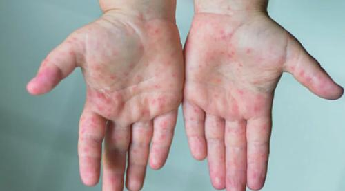 বাড়ছে হামের প্রকোপ, পরীক্ষায় গড়ে শনাক্ত ৩৫ শতাংশ