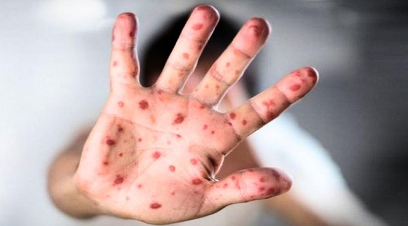 নাটোরে হামের উপসর্গে বিভিন্ন হাসপাতালে ভর্তি ২১