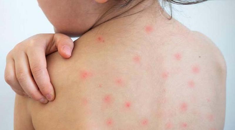 চাঁপাইনবাবগঞ্জে হামে আরও ১ শিশুর মৃত্যু