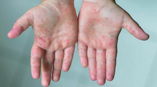 দেশে ২৪ ঘণ্টায় হাম ও হামের উপসর্গ নিয়ে আরও ৭ শিশুর মৃত্যু