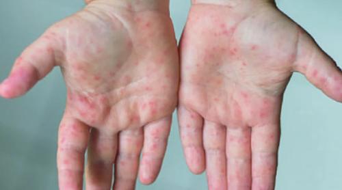 বরিশালে হামের উপসর্গ নিয়ে ২৪ ঘণ্টায় ২ শিশুর মৃত্যু