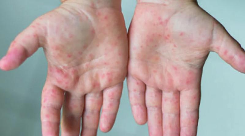 বরিশালে হামের উপসর্গ নিয়ে ২৪ ঘণ্টায় ২ শিশুর মৃত্যু