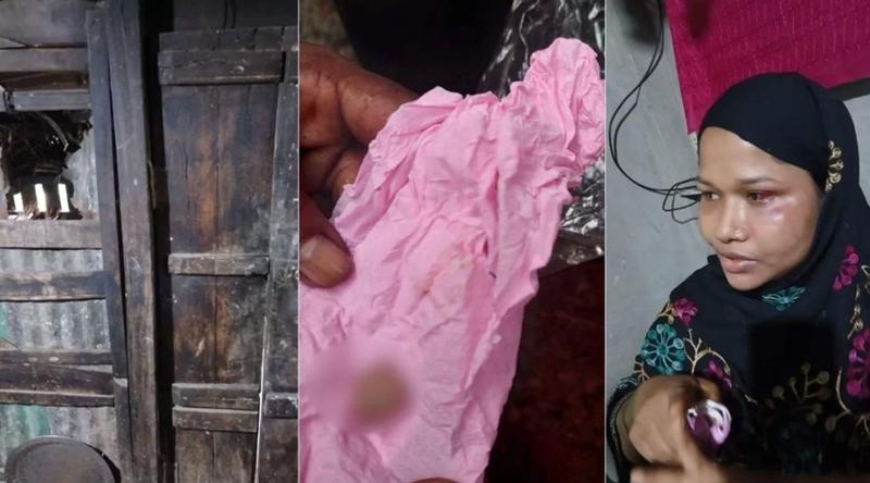 গভীর রাতে চুরির করতে গিয়ে গৃহবধূর কামড়ে চোরের আঙুল বিচ্ছিন্ন