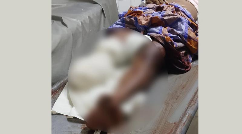 কুষ্টিয়ায় হাসপাতাল থেকে দুর্ঘটনার শিকার ব্যক্তির বিচ্ছিন্ন পা গায়েব