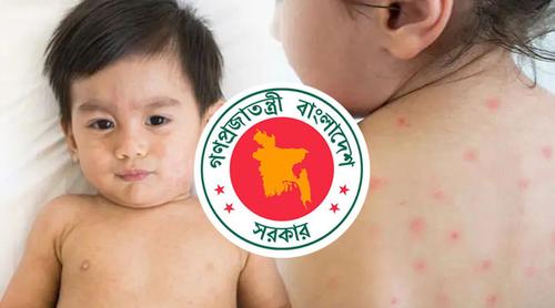 হাম উপসর্গে আরও ৪ শিশুর মৃত্যু