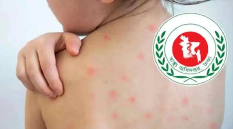 হামের উপসর্গে আরও পাঁচ শিশুর মৃত্যু