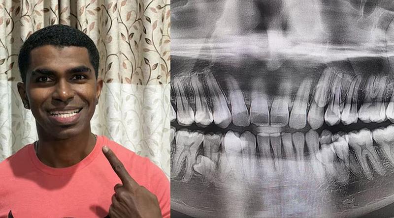 ৪২ দাঁত নিয়ে গিনেস রেকর্ডে মালেশিয়ার  ব্যক্তি!