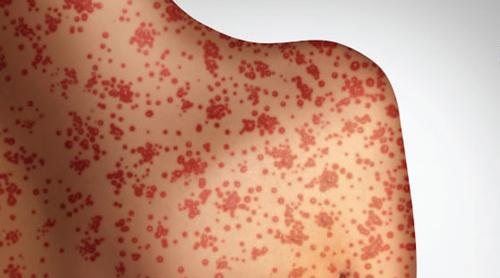 হাম কীভাবে ছড়ায় এবং এর লক্ষণ কী কী?