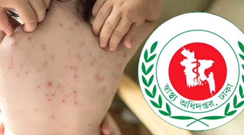 হামের উপসর্গ নিয়ে আরও ৪ শিশুর মৃত্যু