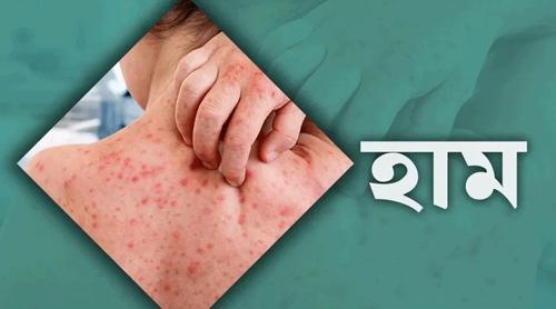 ঈদের দিনেও হাম ও উপসর্গে ৫ শিশুর মৃত্যু