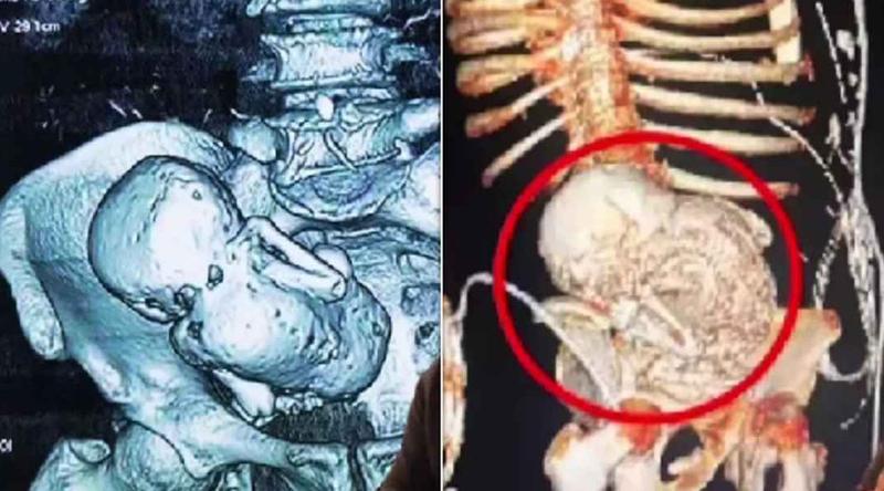 প্রসবের ভয়ে হাসপাতাল থেকে পালিয়েছিলেন, ৩৬ বছর পর পেট থেকে মিলল ‘পাথর শিশু’